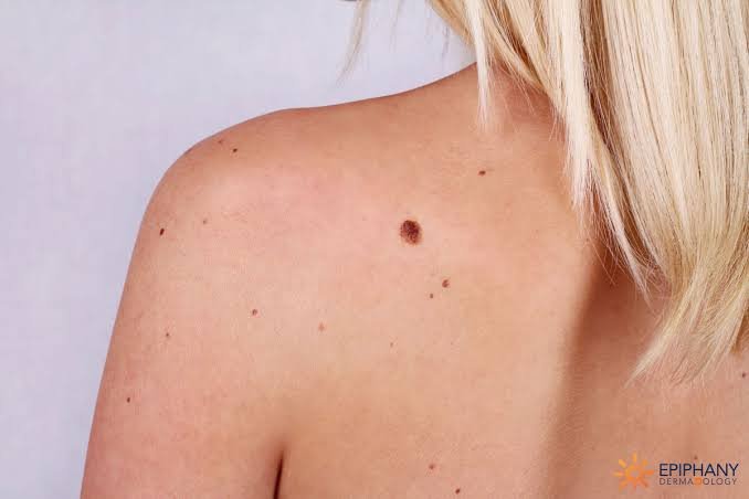 Wart Mole and Birthmark Clinical Removal